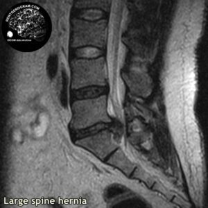 big_hernia_l-spine_MRI_1