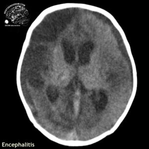 encephalitis_head CT_4