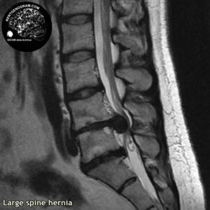 big_hernia_l-spine_MRI_3