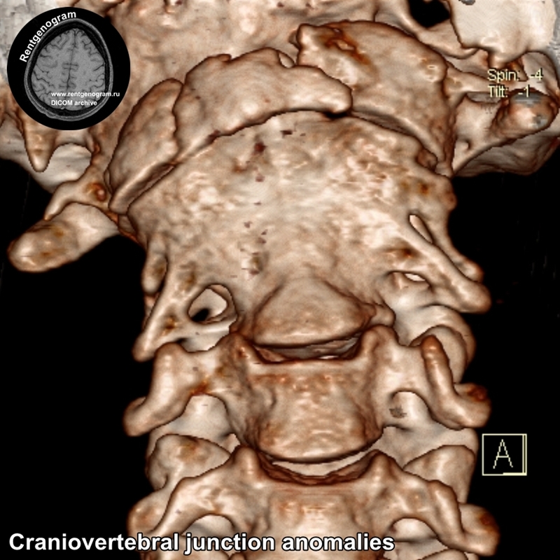 Craniovertebral_junction anomalies_CT_2