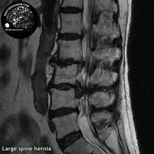 big_hernia_l-spine_MRI_4
