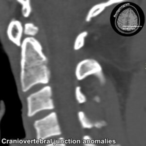 Craniovertebral_junction anomalies_CT_3
