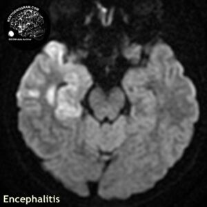 encephalitis_head MRI_2