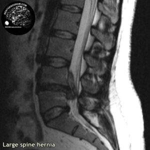 big_hernia_l-spine_MRI_5