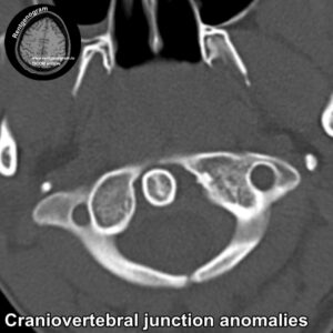 Craniovertebral junction anomalies CT_4