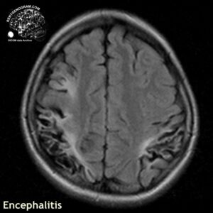 encephalitis_head MRI_3