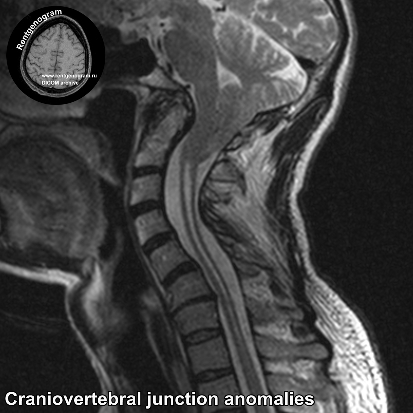 Craniovertebral_junction anomalies_MRI