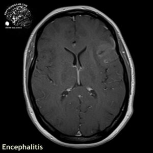 encephalitis_head MRI_5