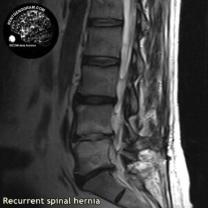 recurrent_hernia_l-spine_MRI_2