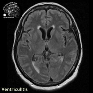 ventriculitis_head MRI_2