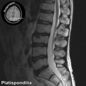 Platispondilia_MRI_3