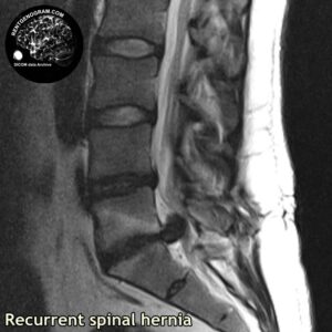 recurrent_hernia_l-spine_MRI_3