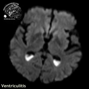 ventriculitis_head MRI_3