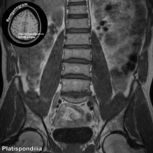 Platispondilia_MRI_4