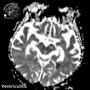 ventriculitis_head MRI_4