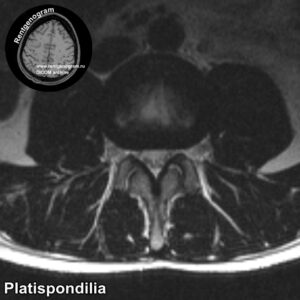 Platispondilia_MRI_5