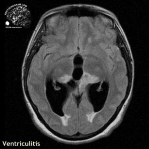 ventriculitis_head MRI_5