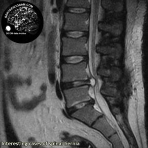 interest_hernia_l-spine_MRI_1