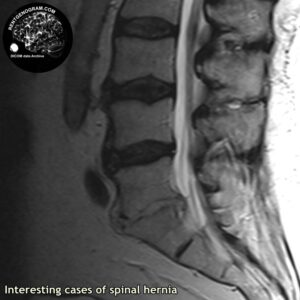 interest_hernia_l-spine_MRI_2