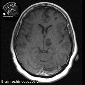 rare_echinococcosis_head MRI_3