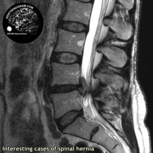 interest_hernia_l-spine_MRI_3