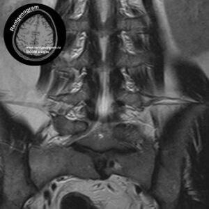 Sacral developmental abnormality_MRI_3