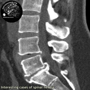 interest_hernia_l-spine_MRI_4