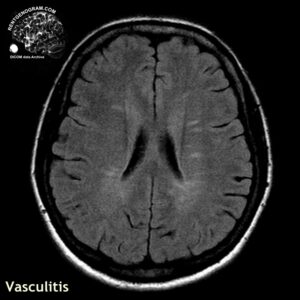 rare_vasculitis_head MRI_2