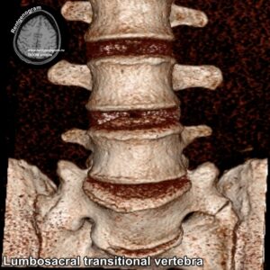 Lumbosacral transitional vertebra_CT_1