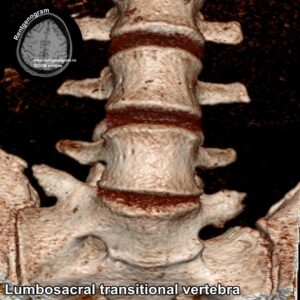 Lumbosacral transitional vertebra_CT_5
