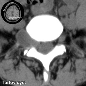Perineural_cyst_CT_3