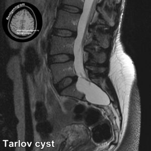 Tarlov cyst_MRI_1