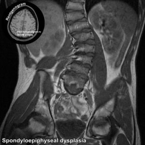 Other_spine_anomaly_MRI_5