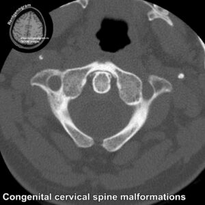 Congenital cervical spine malformations CT_5