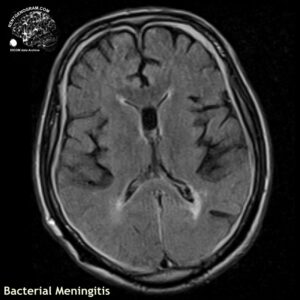 meningitis_head MRI_1