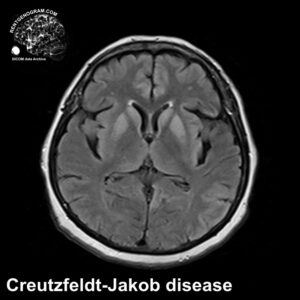 creutzfeldt-jakob_disease_mri_flair_tra