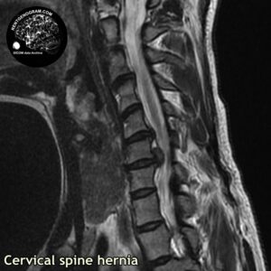 big_hernia_c-spine_MRI_1