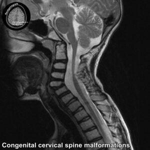 Congenital cervical spine malformations MRI_1