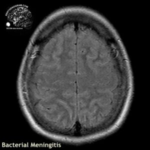 meningitis_head MRI_2