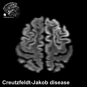 creutzfeldt-jakob_disease_mri_dwi_tra
