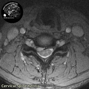 big_hernia_c-spine_MRI_2