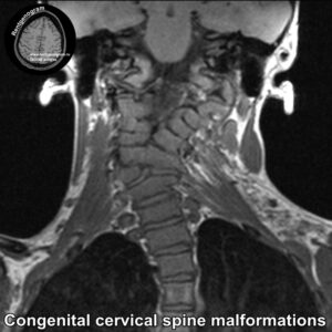 Congenital cervical spine malformations MRI_2