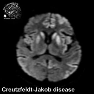 creutzfeldt-jakob_disease_mri_dwi_ax