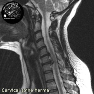 big_hernia_c-spine_MRI_3