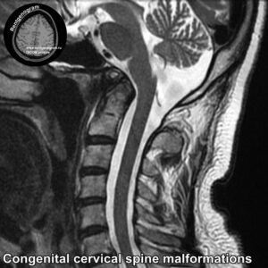 Congenital cervical spine malformations MRI_3