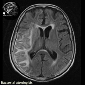 meningitis_head MRI_4