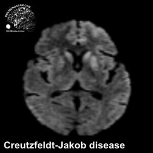 creutzfeldt-jakob_disease_mri_dwi
