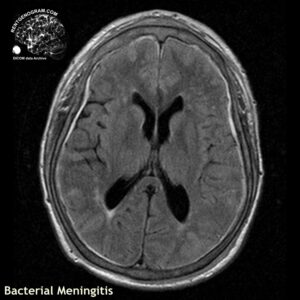 meningitis_head MRI_5