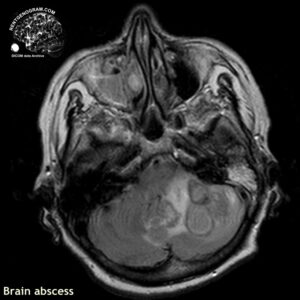 abscess_head MRI_1