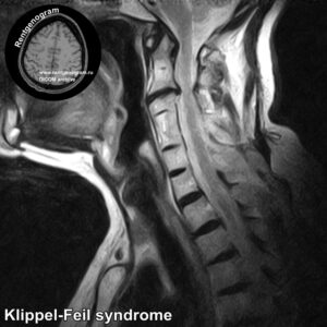 Klippel-Feil syndrome_MRI_1